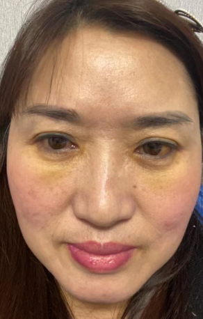 去眼袋手术