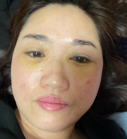去眼袋手术