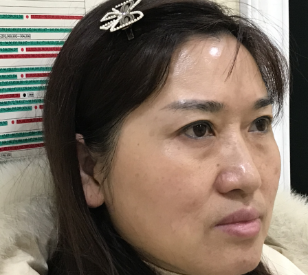 去眼袋手术