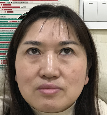 去眼袋手术