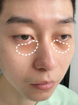 眼袋