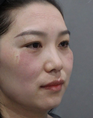 去眼袋手术
