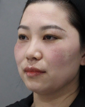 去眼袋手术