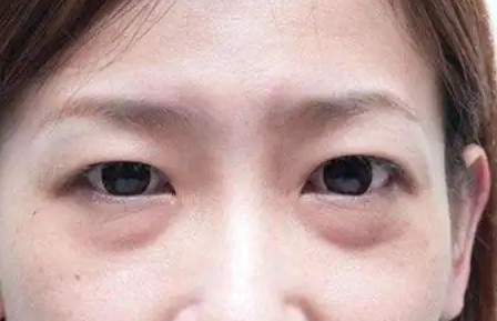 眼袋