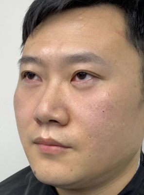 去眼袋手术