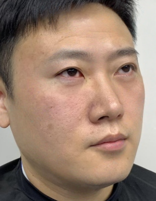 去眼袋手术