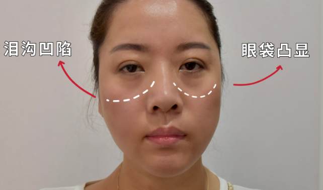 眼袋