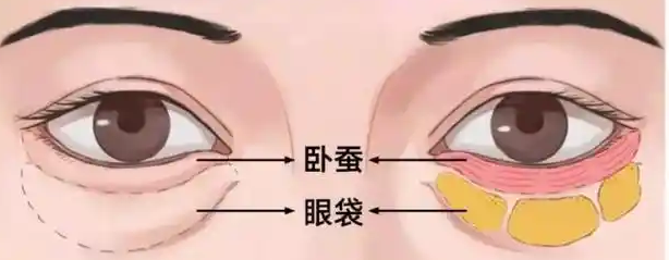 眼袋