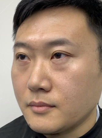 去眼袋手术