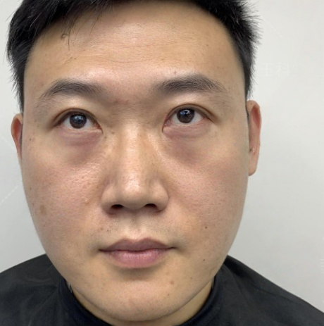 去眼袋手术