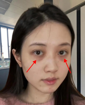 去眼袋手术