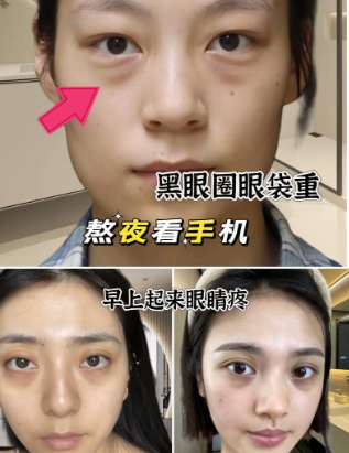 去眼袋手术