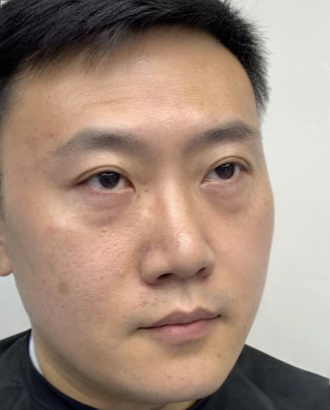 去眼袋手术