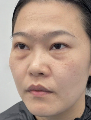 去眼袋手术