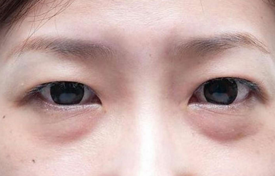 去眼袋手术