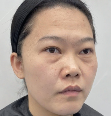 去眼袋手术