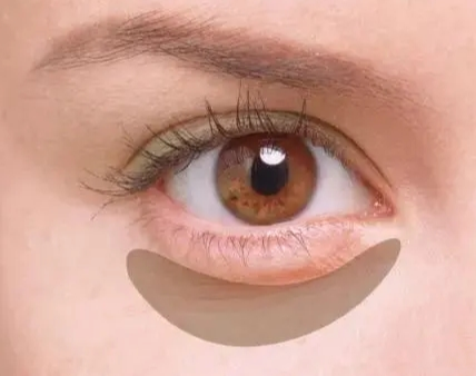 眼袋