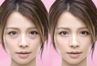眼袋
