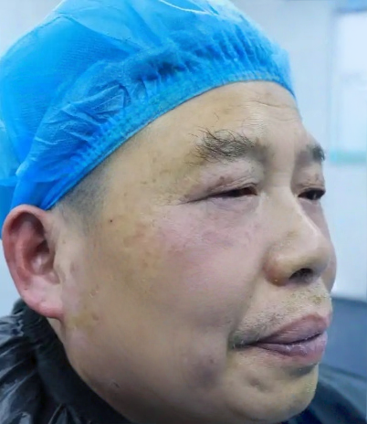 去眼袋手术