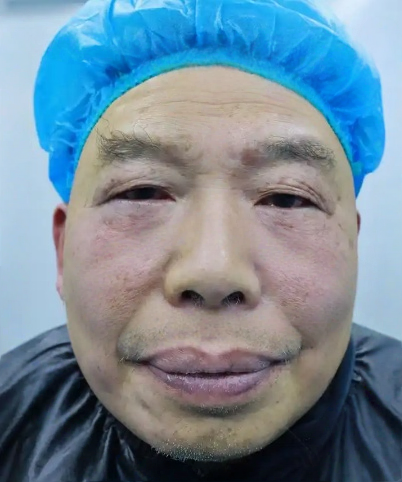 去眼袋手术