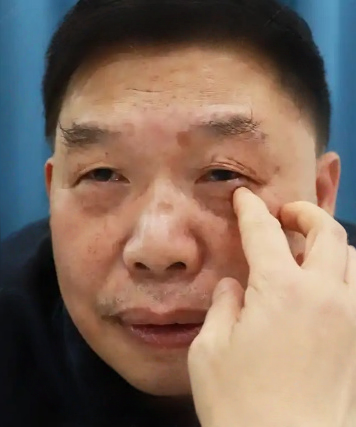 去眼袋手术