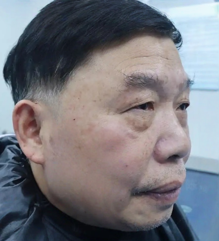 去眼袋手术