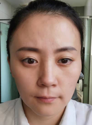 去眼袋手术