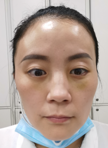 去眼袋手术