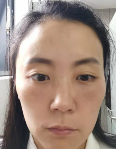 去眼袋手术
