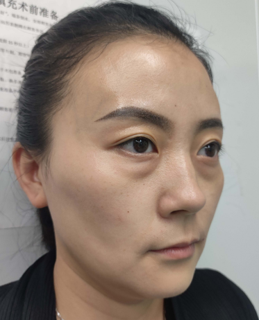 去眼袋手术