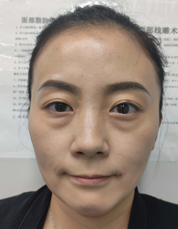 去眼袋手术