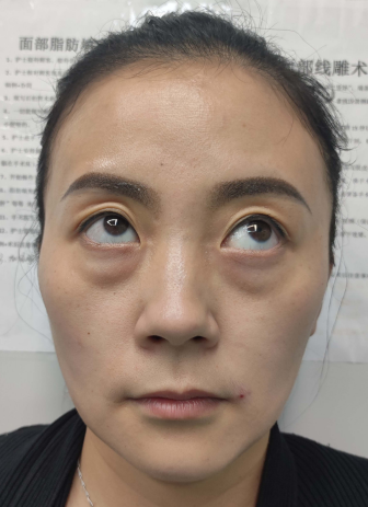 去眼袋手术