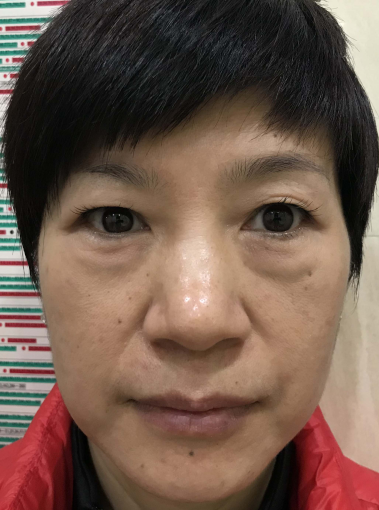 去眼袋手术