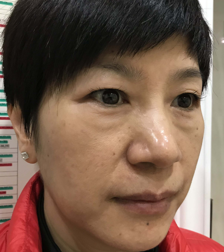去眼袋手术