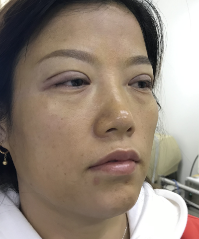 去眼袋手术