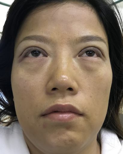 去眼袋手术