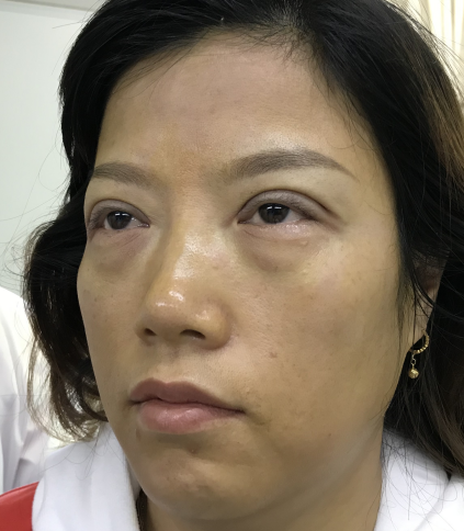 去眼袋手术