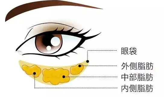 去眼袋手术