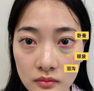 去眼袋手术