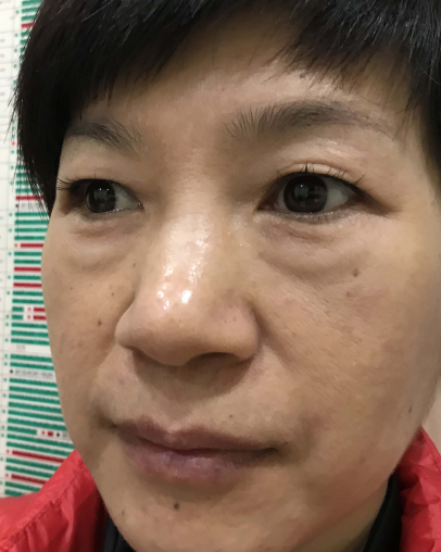 去眼袋手术
