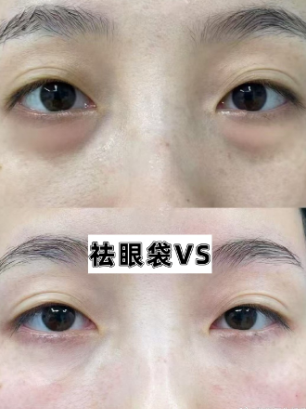 去眼袋手术
