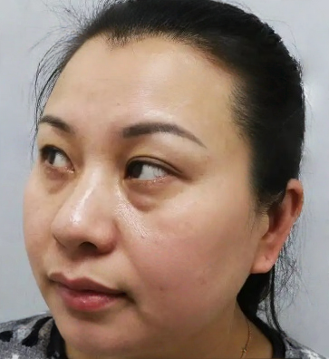去眼袋手术