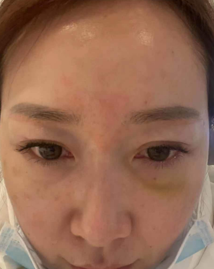 去眼袋手术