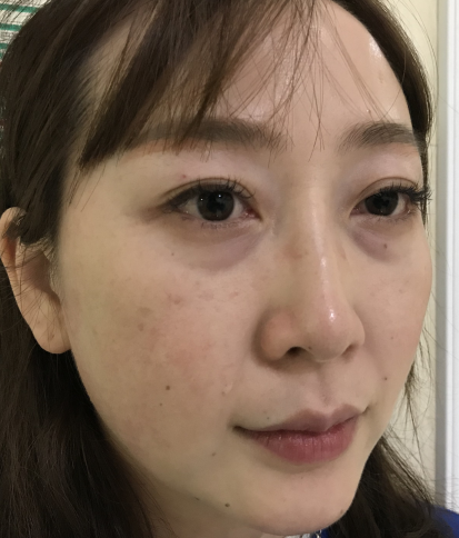 去眼袋手术