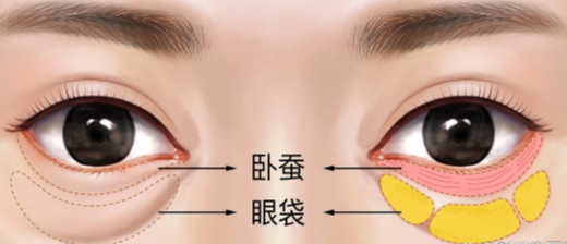 去眼袋手术