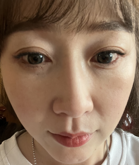去眼袋手术