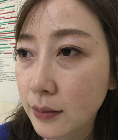 去眼袋手术