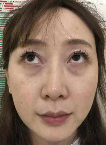 去眼袋手术
