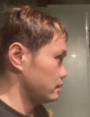 去眼袋手术