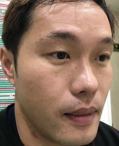 去眼袋手术